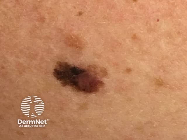 Superficial spreading melanoma