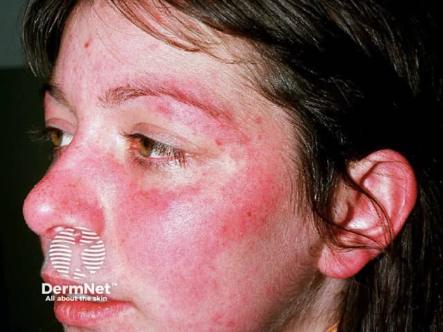 Systemic lupus erythematosus