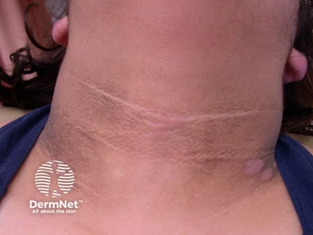 Acanthosis nigricans*