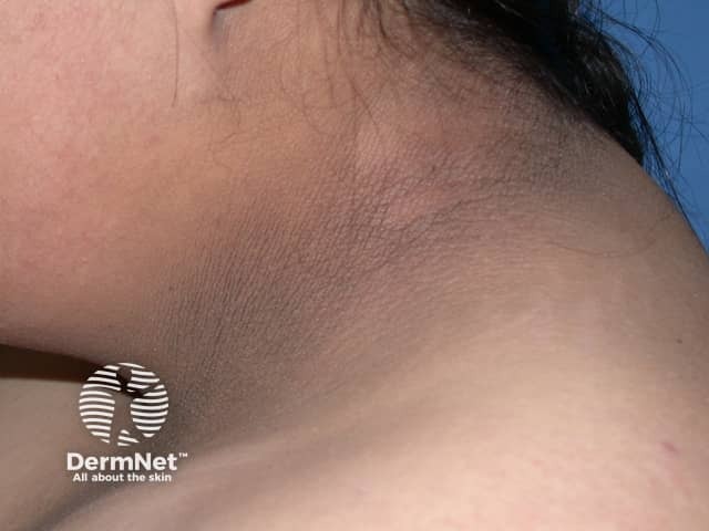 Acanthosis nigricans