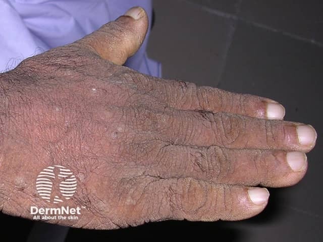 Acanthosis nigricans