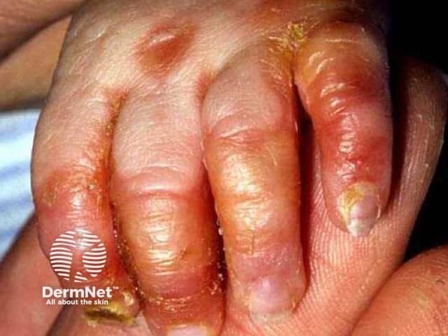 Acrodermatitis enteropathica