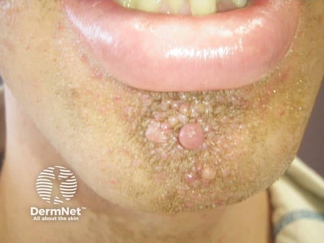 Angiofibromas in tuberous sclerosis