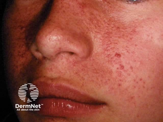 Angiofibromas in tuberous sclerosis