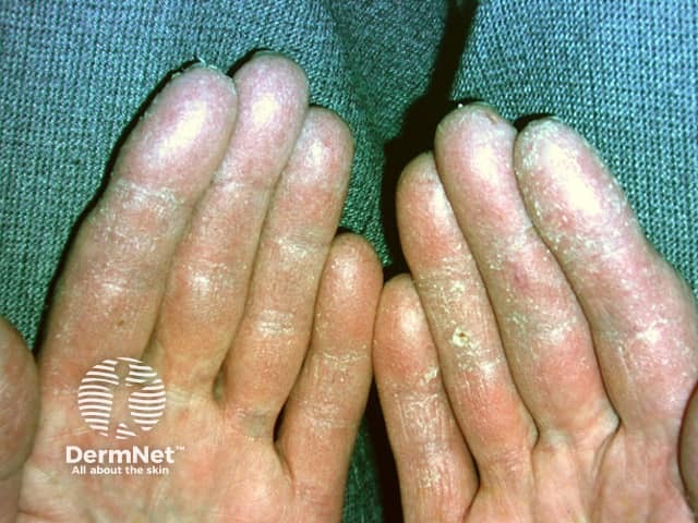 Acrokeratosis neoplastica