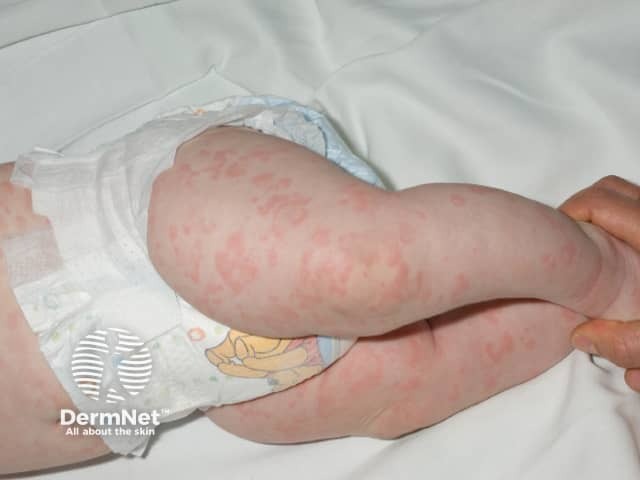 Cryopyrin-associated periodic syndrome rash