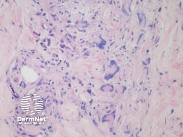 Histology of cutaneous granuloma due to Crohn disease, New Zealand Medical Journal. 2006