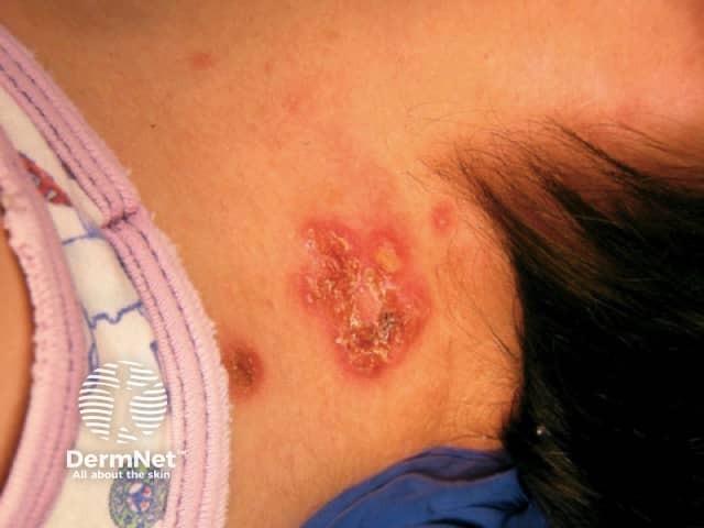 Epidermolysis bullosa