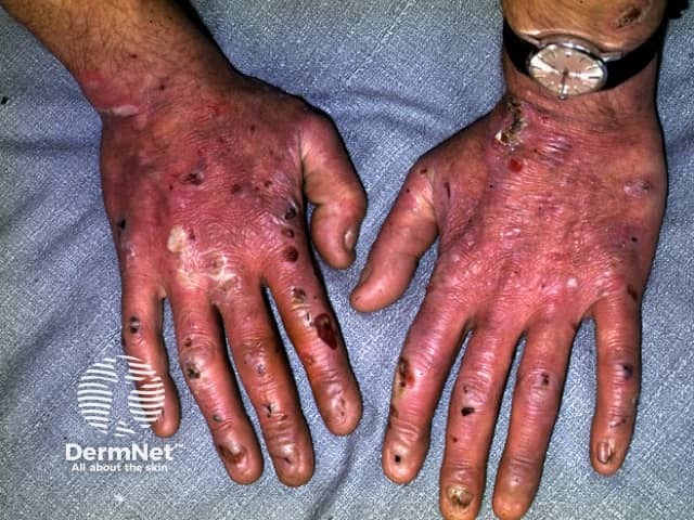 Epidermolysis bullosa