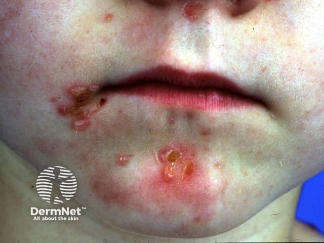 Epidermolysis bullosa