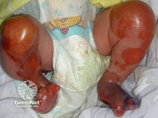 Epidermolysis bullosa