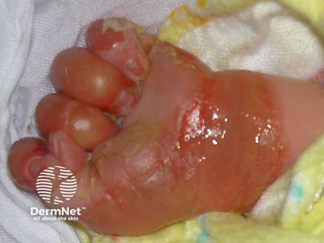 Epidermolysis bullosa