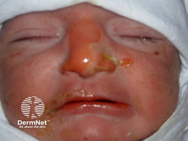 Epidermolysis bullosa