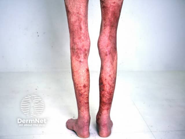 Necrolytic migratory erythema