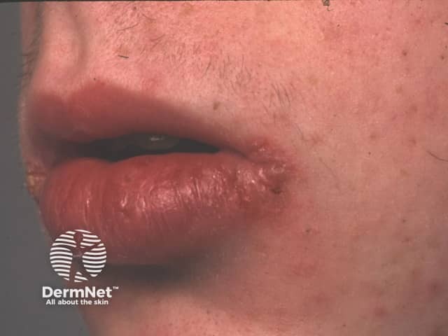 Granulomatous cheilitis due to Crohn disease