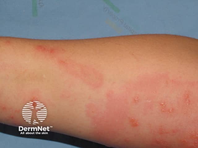 Contact dermatitis