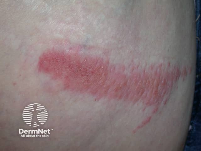 Contact dermatitis