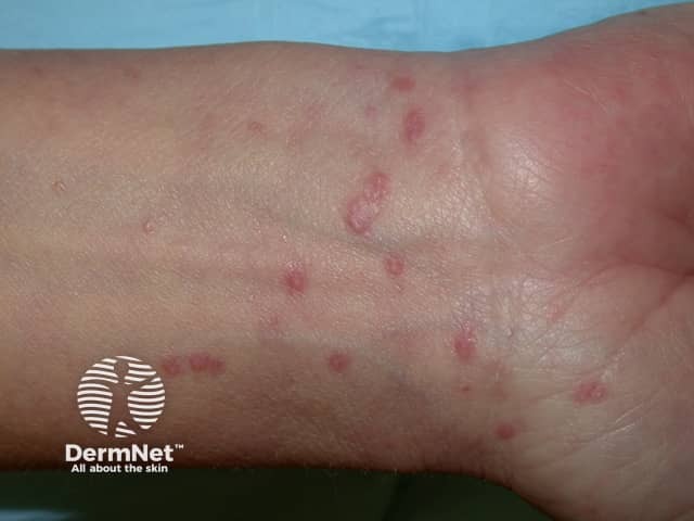 Lichen planus