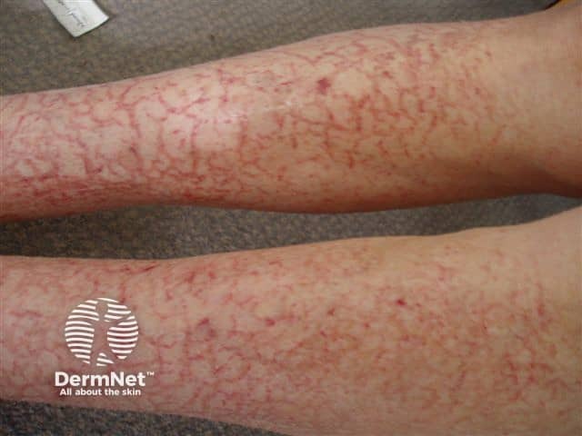 Venous eczema