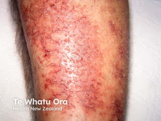 Venous eczema