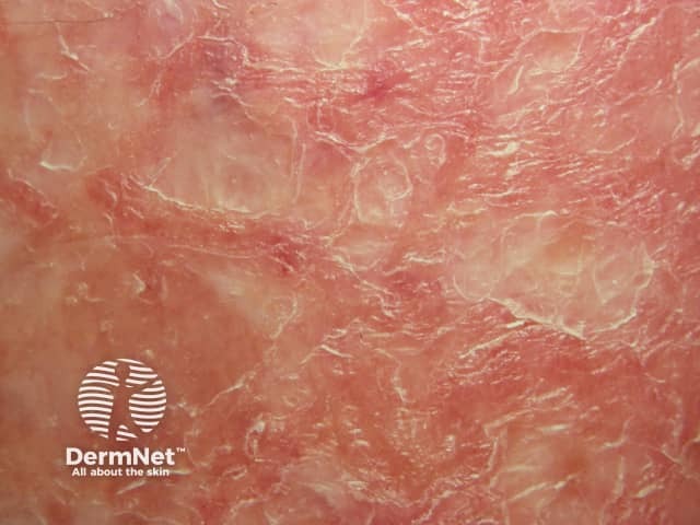 Venous eczema