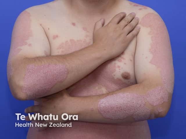 Psoriasis