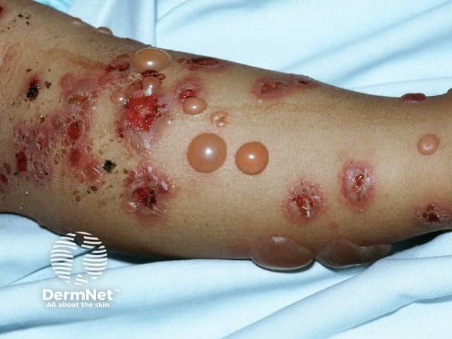 Bullous pemphigoid