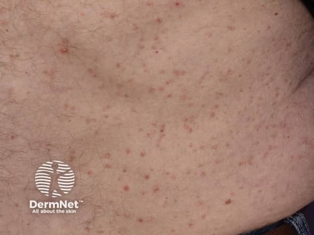 Transient acantholytic dermatosis