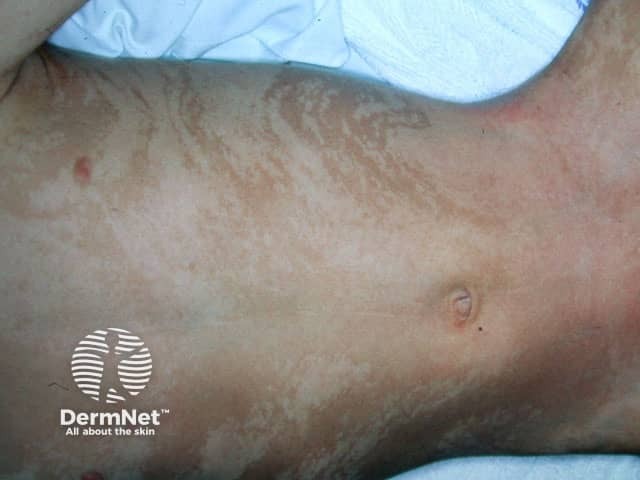 Hypomelanosis of Ito