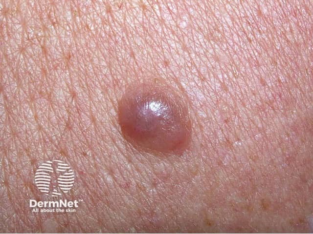 Nodular melanoma