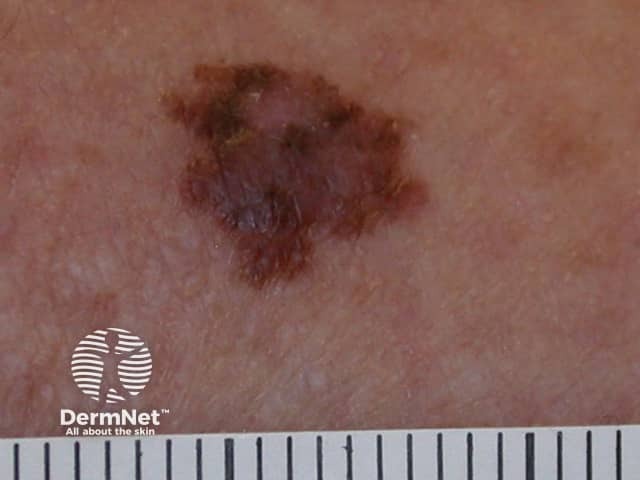 Superficial spreading melanoma