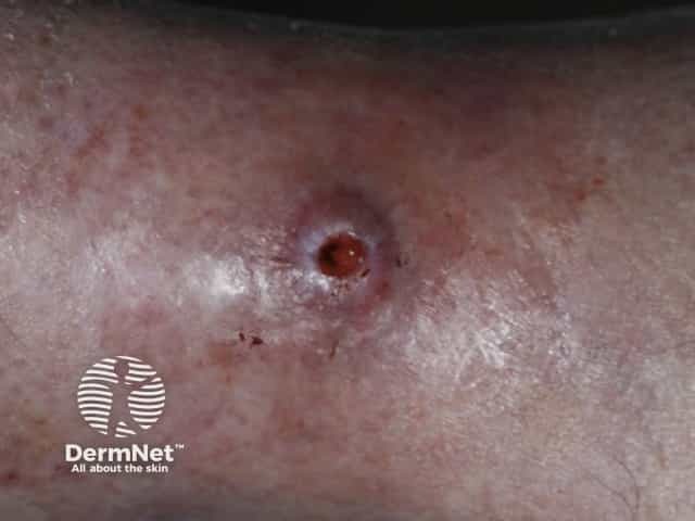 Morgellon disease