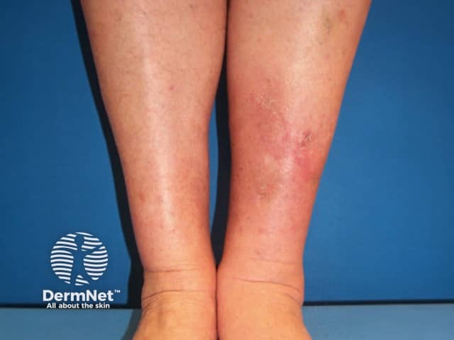 Pretibial myxoedema