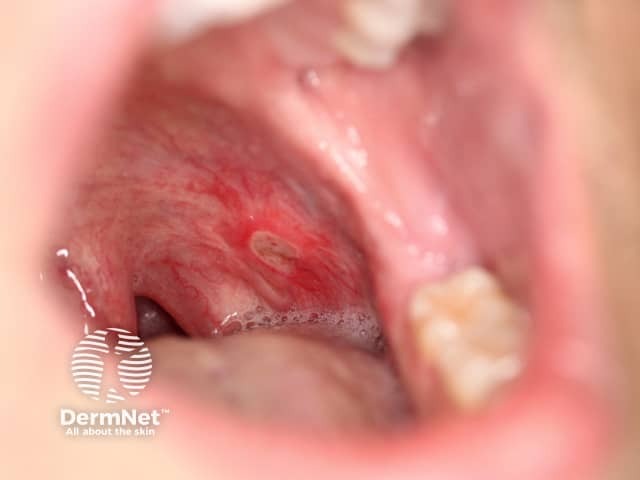 Oral Crohn disease