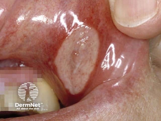 Behcet ulcer