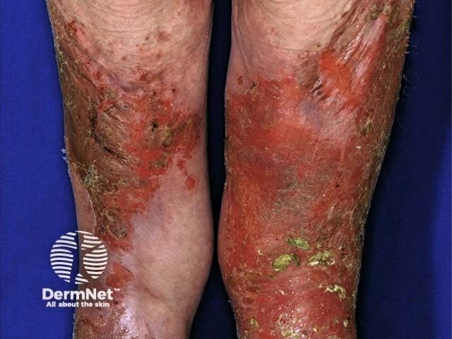 Necrolytic migratory erythema