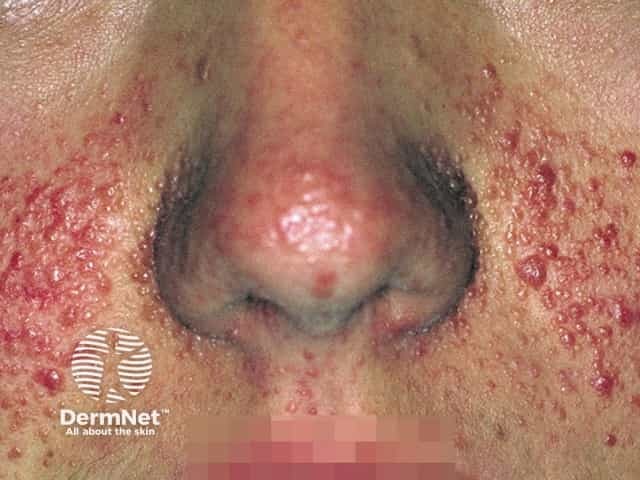 Angiofibromas in tuberous sclerosis