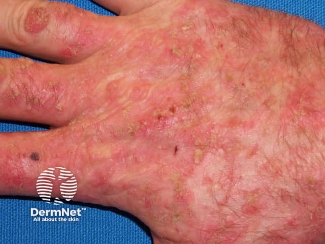 Actinic keratoses