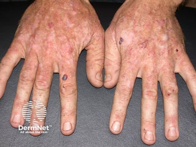 Actinic keratoses