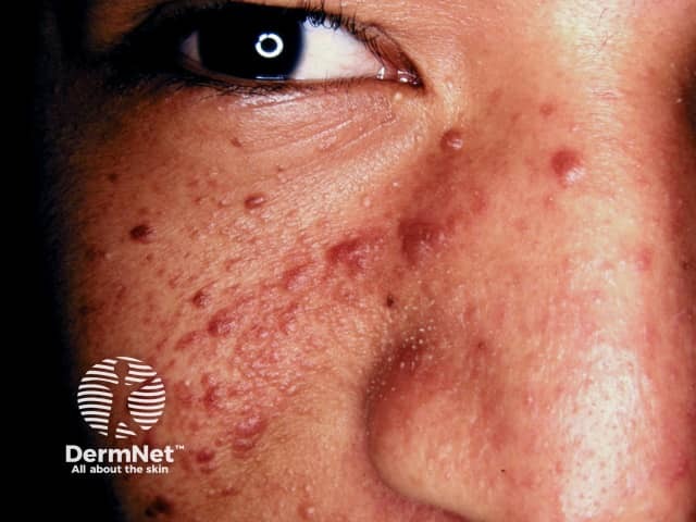 Angiofibromas in tuberous sclerosis