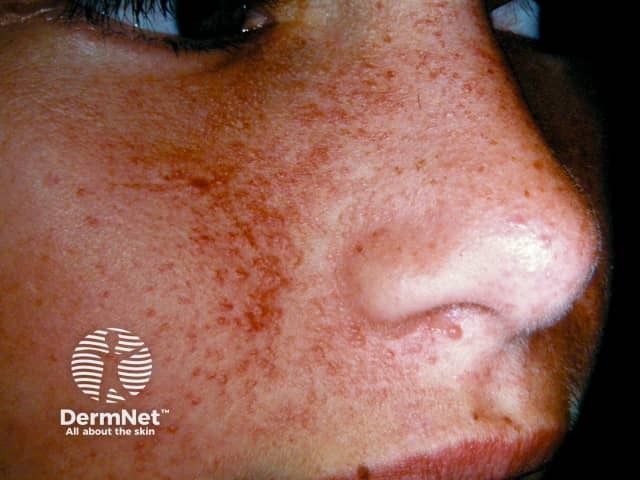 Angiofibromas in tuberous sclerosis