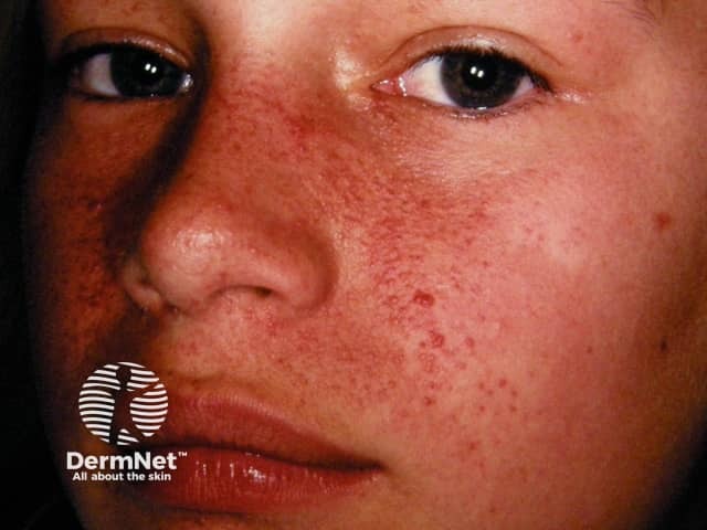 Angiofibromas in tuberous sclerosis