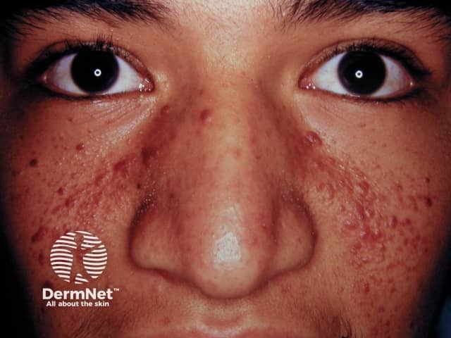 Angiofibromas in tuberous sclerosis