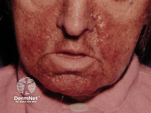 Angiofibromas in tuberous sclerosis