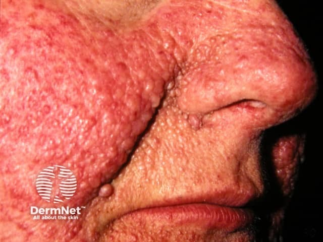 Angiofibromas in tuberous sclerosis