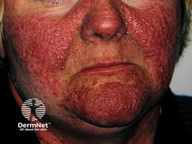 Angiofibromas in tuberous sclerosis