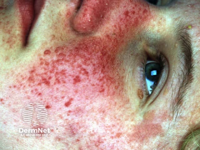 Angiofibromas in tuberous sclerosis