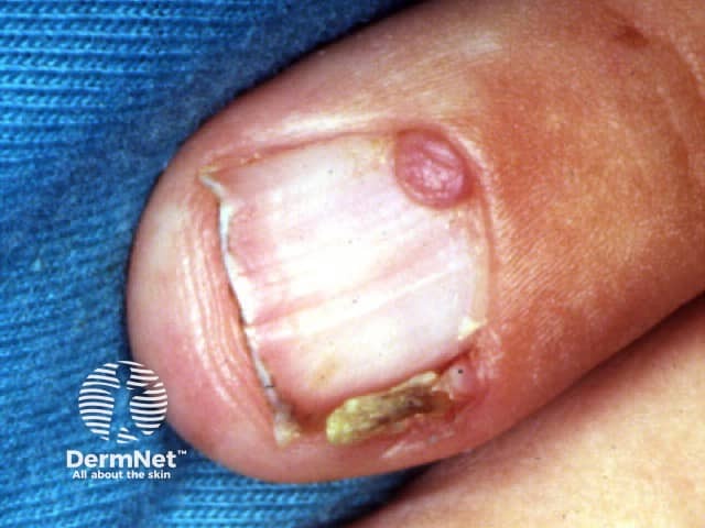 Periungual fibroma in tuberous sclerosis