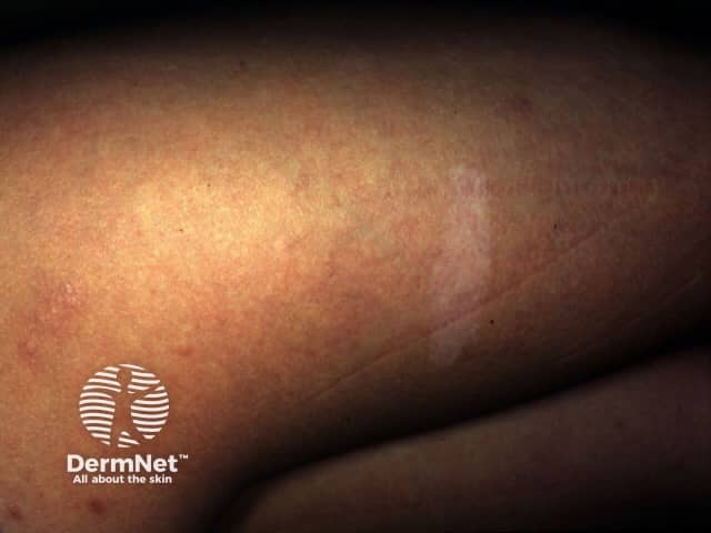 Ash leaf marks in tuberous sclerosis