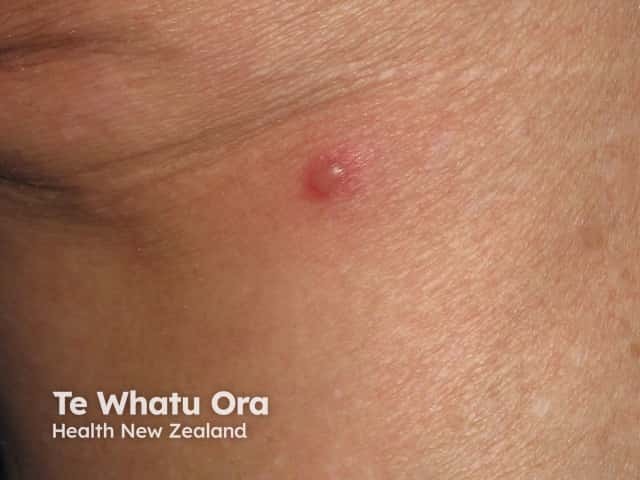 Skin rash due to bowel bypass syndrome